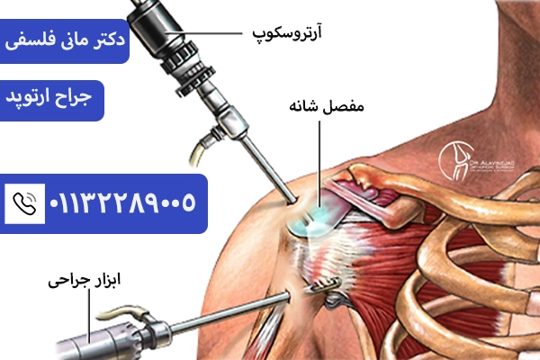 جراحی آرتروسکوپی شانه