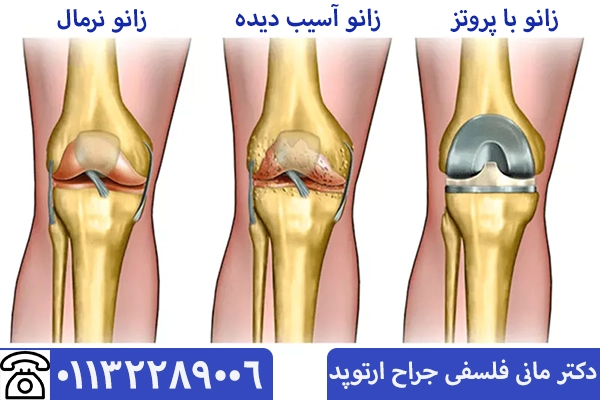 جراحی تعویض مفصل زانو