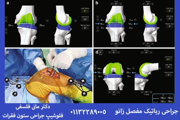 تعویض مفصل زانو