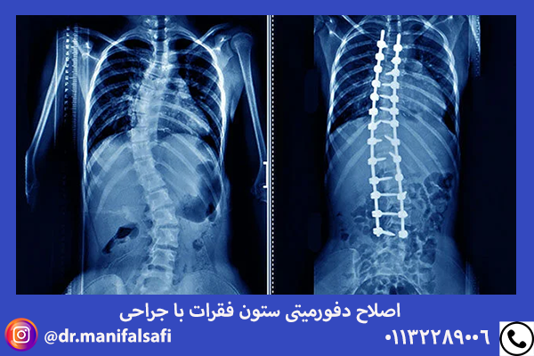 جراحی ستون مهره ها