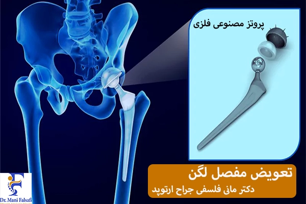 پروتز مفصل لگن