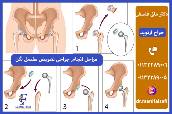 مراحل جراحی تعویض مفصل لگن
