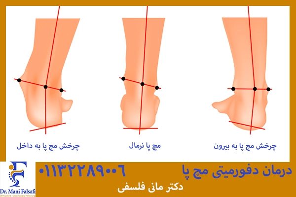 درمان دفورمیتی مچ پا