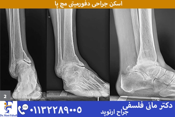 اسکن دفورمیتی مچ پا