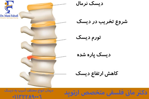 انواع آسیب به دیسک کمر