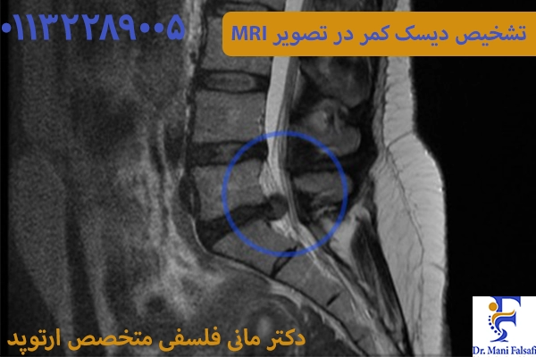 تصویر MRI دیسک کمر