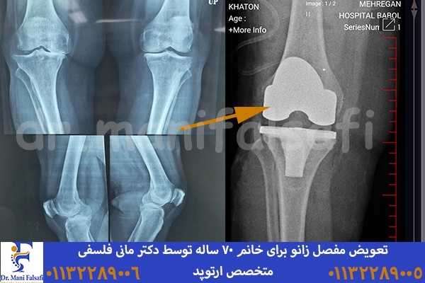 نمونه جراحی تعویض مفصل زانو دکتر مانی فلسفی