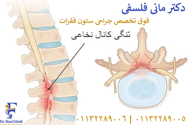 تنگی کانال نخاعی