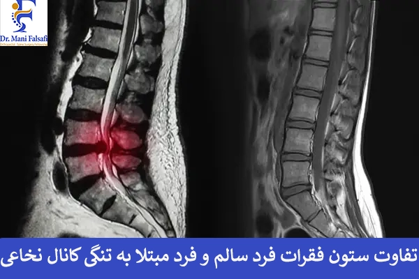 رادیولوژی تنگی کانال نخاعی