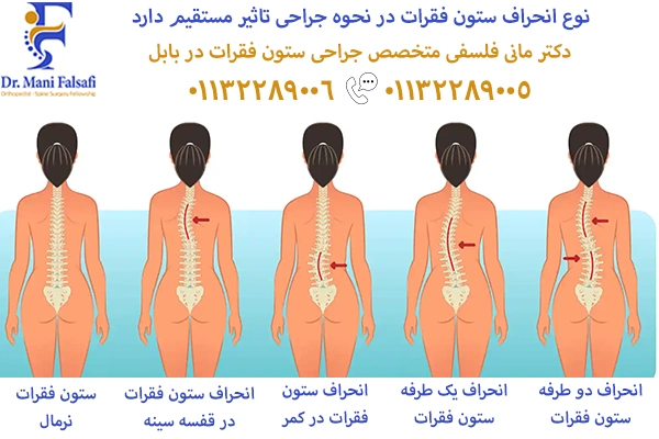 جراحی انحرافات ستون فقرات