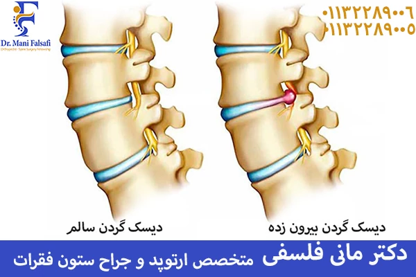 دیسک گردن