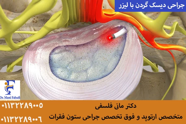 جراحی دیسک گردن با لیزر