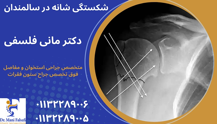 دوره نقاهت شکستگی شانه در سالمندان