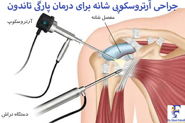 جراحی آرتروسکوپی شانه برای درمان پارگی تاندون شانه