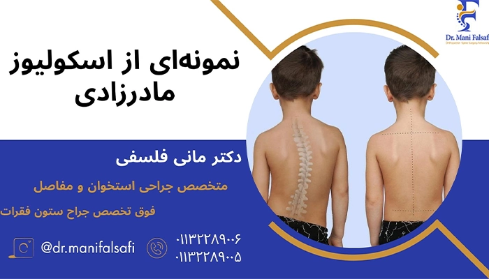 اسکولیوز مادرزادی