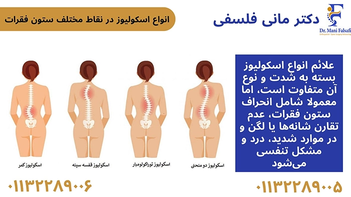 انواع اسکولیوز