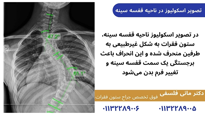 رادیولوژی اسکولیوز