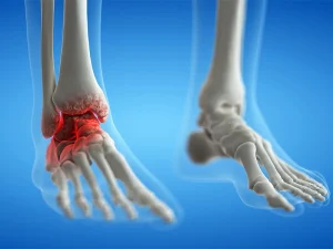 جراحی آرتروز مچ پا در بابل