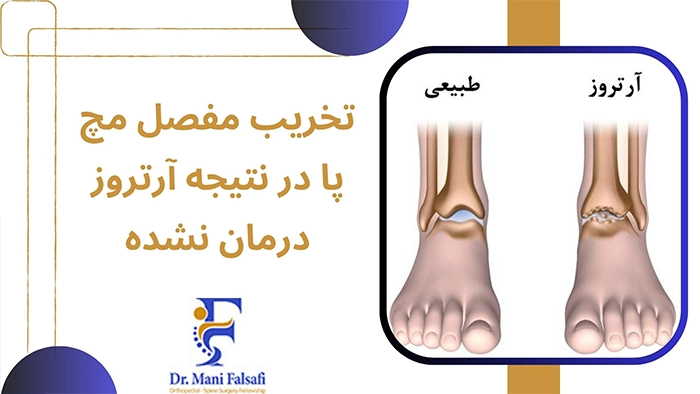 آرتروز مچ پا