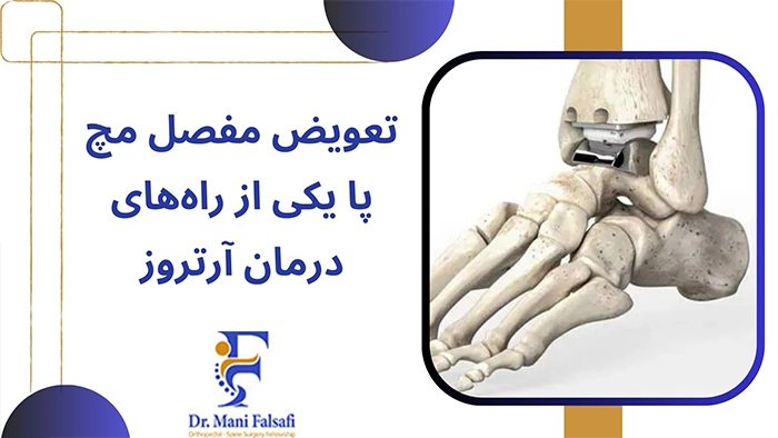 تعویض مفصل مچ پا برای درمان آرتروز