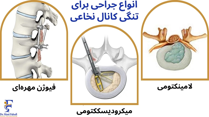 جراحی برای درمان تنگی کانال نخاعی