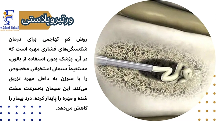 درمان شکستگی مهره کمر