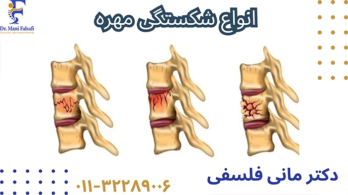انواع شکستگی مهره
