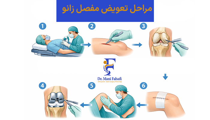 مراحل تعویض مفصل زانو