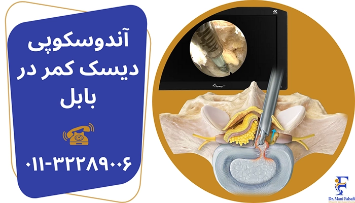 آندوسکوپی دیسک کمر