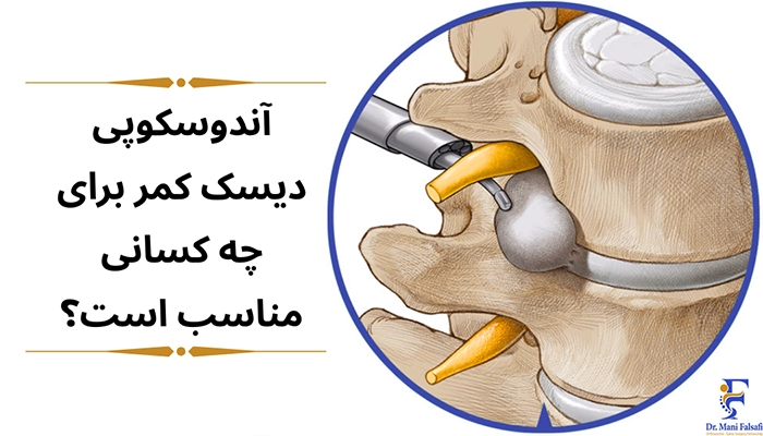 کاندیدای مناسب آندوسکوپی دیسک کمر