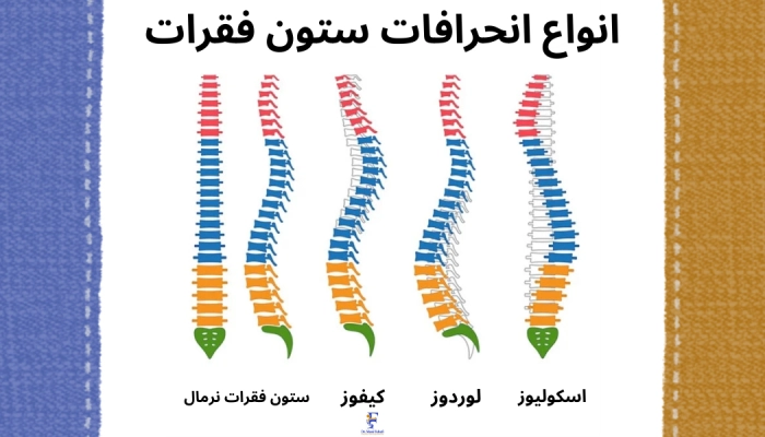 انواع انحراف ستون فقرات