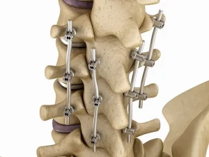 جراحی فیوژن کمر در بابل