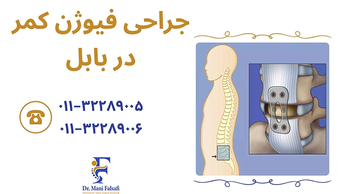 جراحی فیوژن کمر در بابل