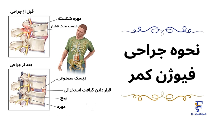 نحوه انجام عمل فیوژن کمر
