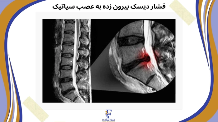 ام آر آی سیاتیک