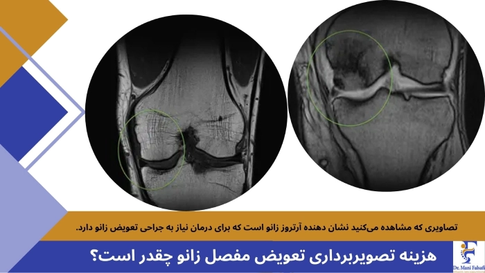 هزینه تصویربرداری برای تعویض مفصل زانو