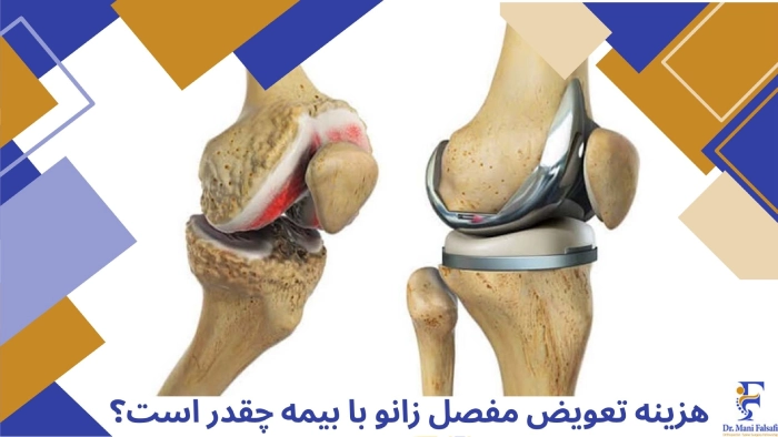 هزینه تعویض مفصل زانو با بیمه