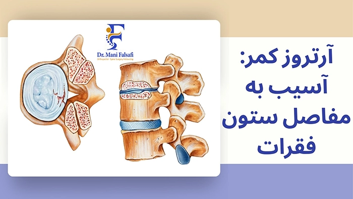 آرتروز کمر