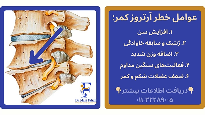 علت آرتروز کمر