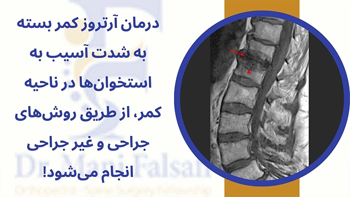 درمان آرتروز کمر