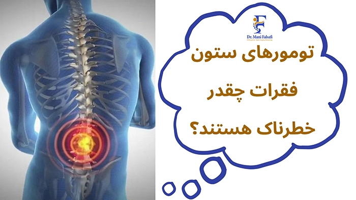تومورهای ستون فقرات