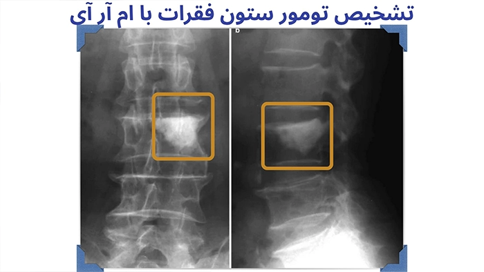 تصویر تومور ستون فقرات