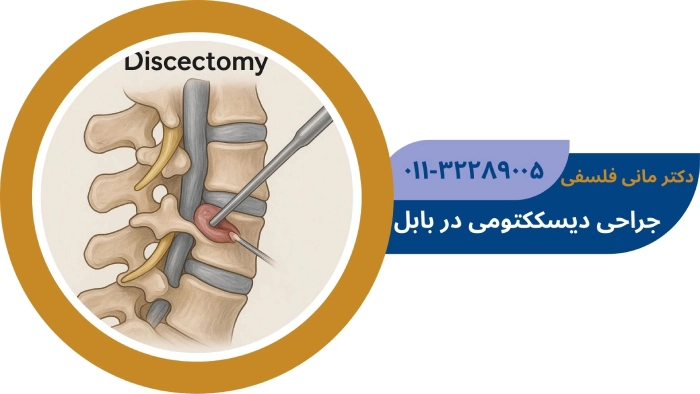دیسککتومی در بابل