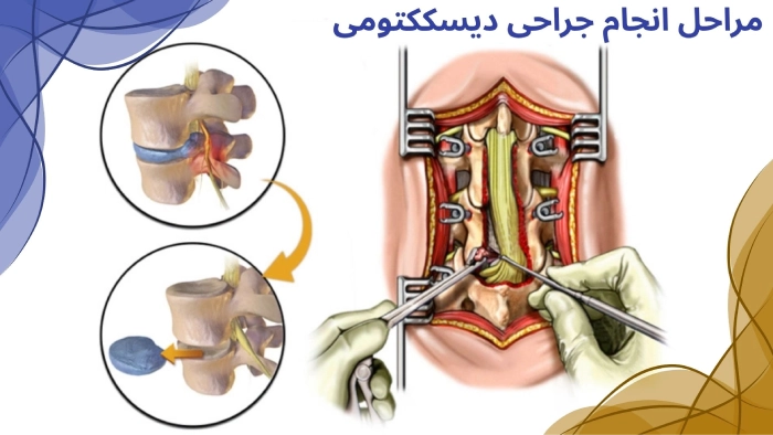 مراحل انجام دیسککتومی