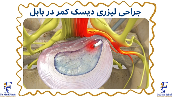 جراحی لیزری دیسک کمر