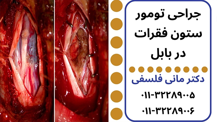 جراحی تومور ستون فقرات در بابل