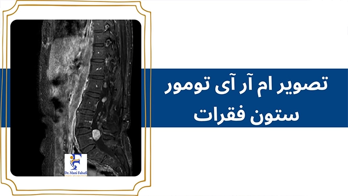 تشخیص جراحی تومور ستون فقرات