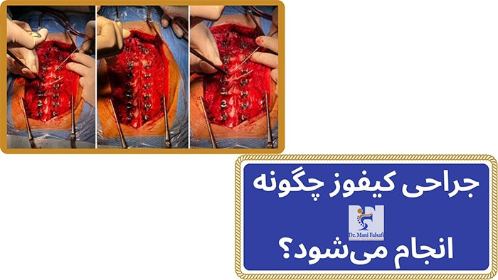 مراحل جراحی کیفوز
