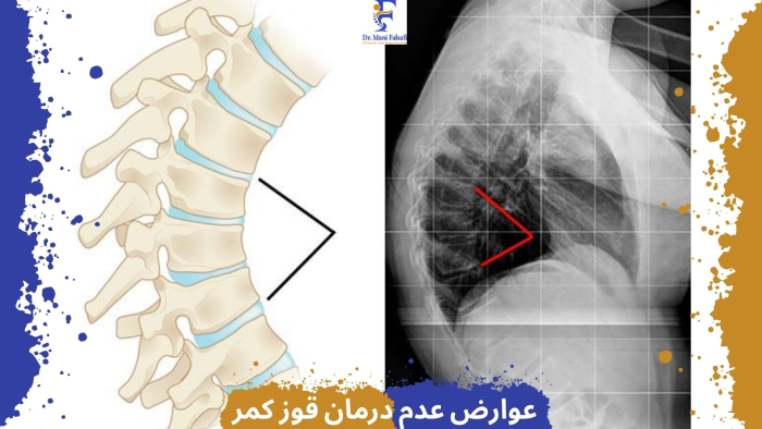عوارض قوز کمر