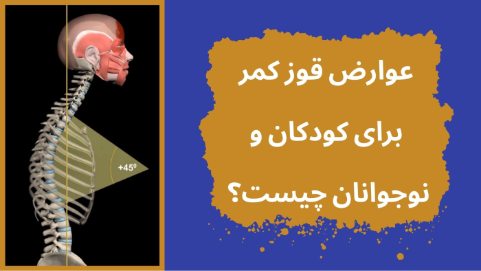 عوارض قوز کمر نوجوانان